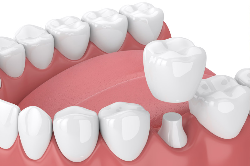 Dental Crowns in Lumberton