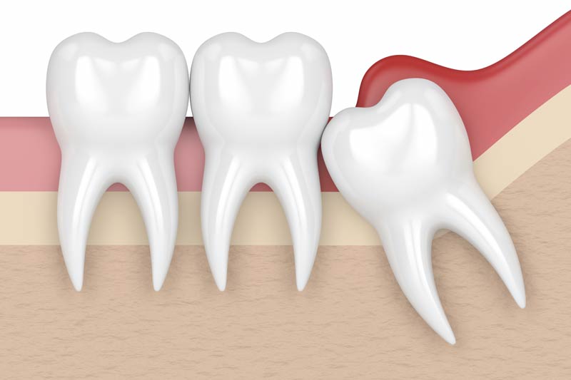 Wisdom Tooth Removal in Lumberton